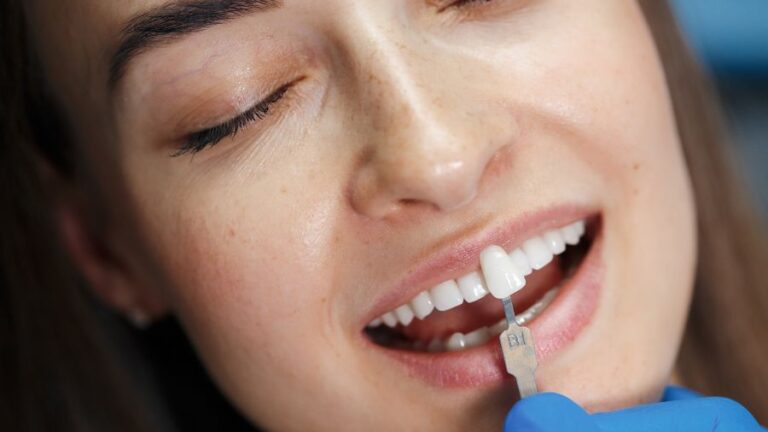 sbiancamento denti