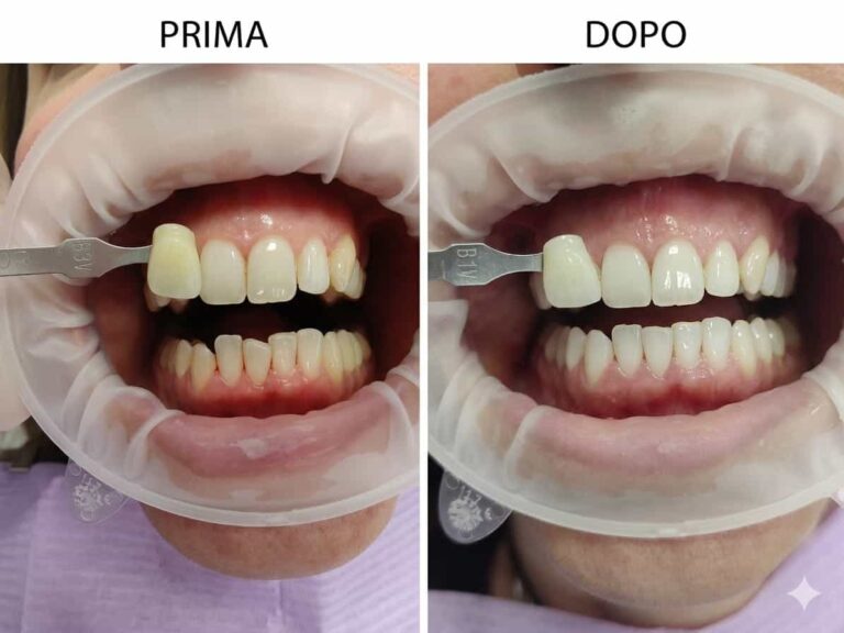 Risultato sbiancamento denti domiciliare Latina - ED Dental Studio